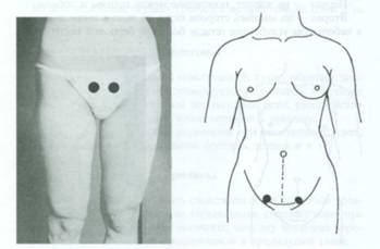 Акупунктурные точки при менструации
